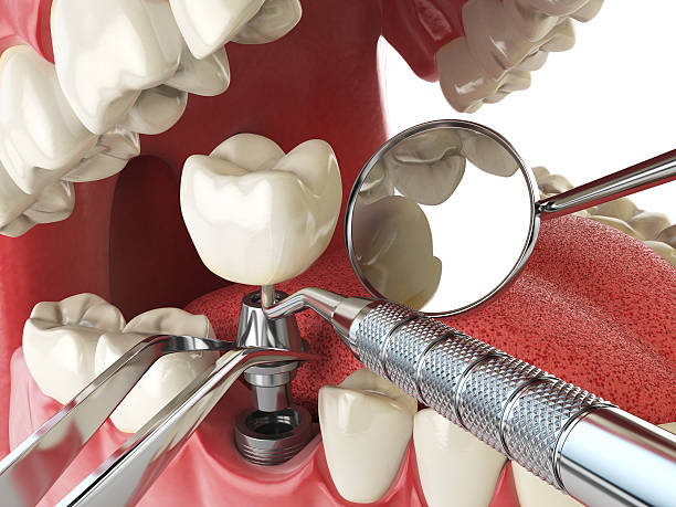 Best Urgent Care for Lost Fillings or Crowns in Ten Mile Creek, MD
